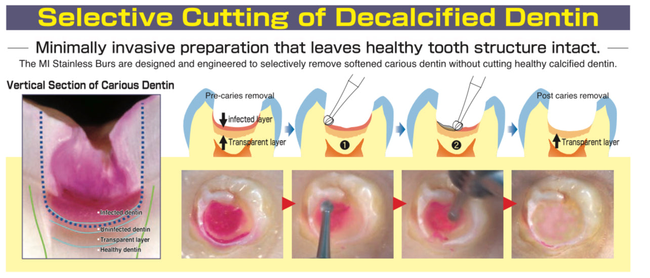 Mani- Minimium Intervention Stainless steel burs for removing caries and not healthy dentine