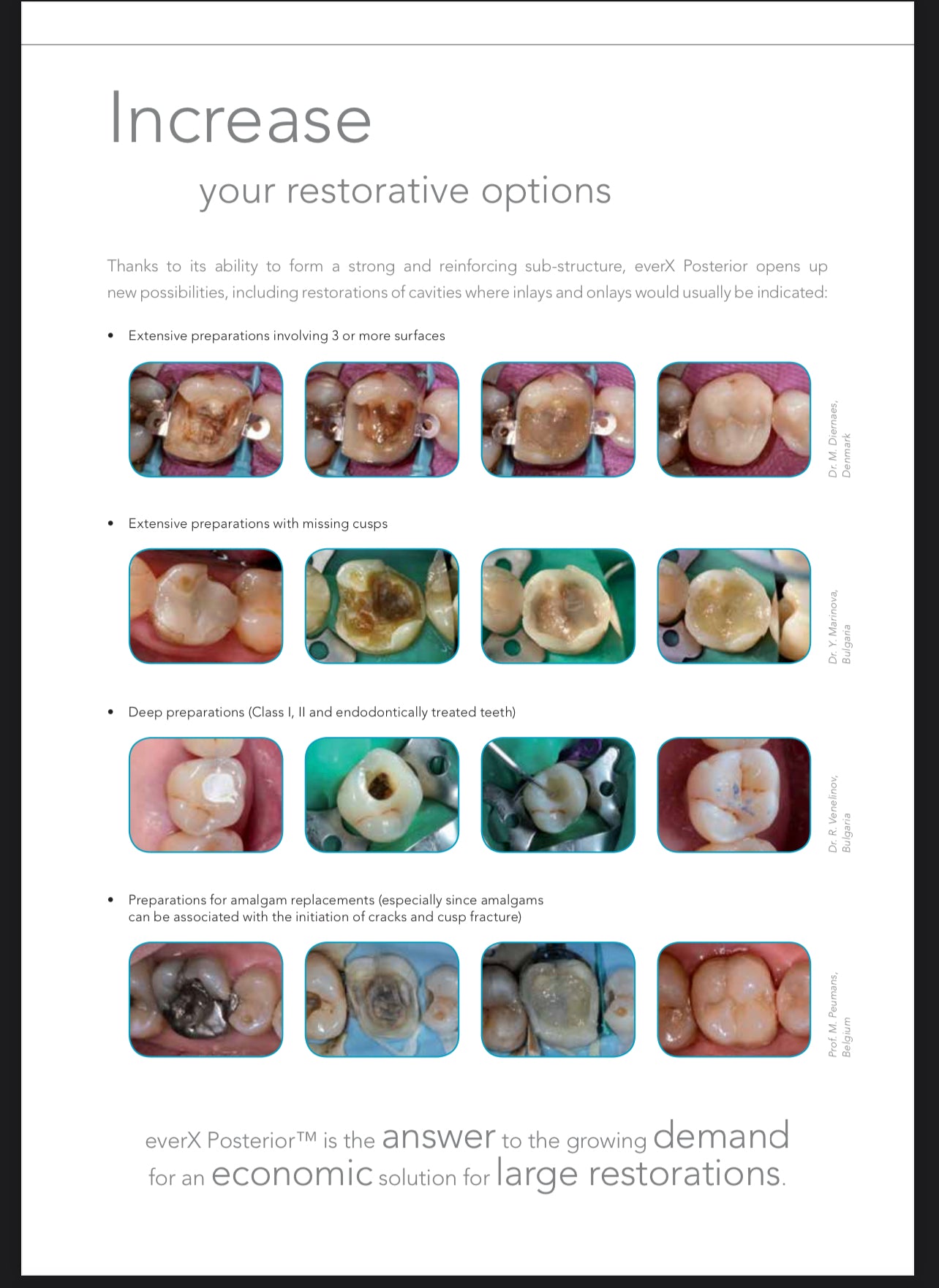 EverX Posterior Unitip